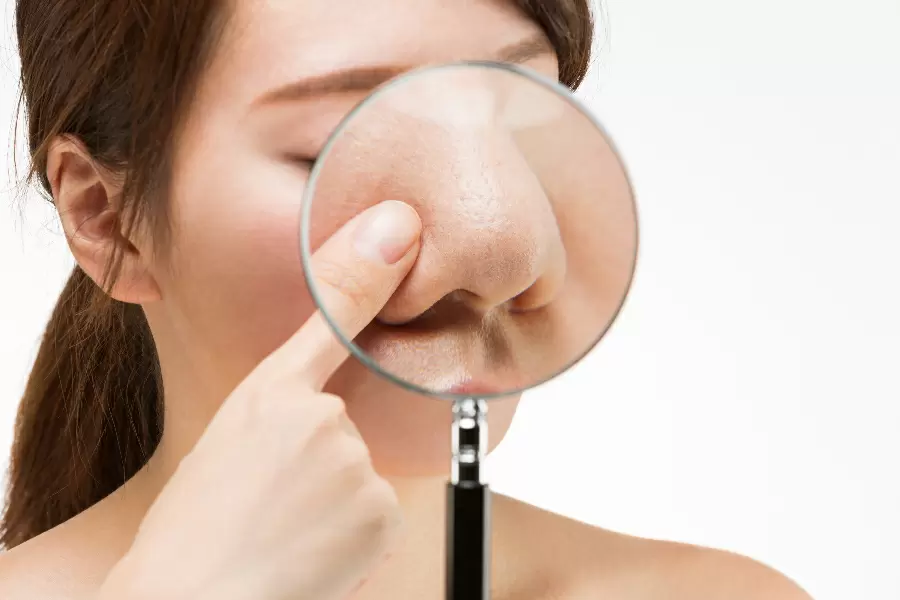 とくに目立つ小鼻の毛穴開きを改善する方法はあるの あしたの美肌 専門家による美容コラム